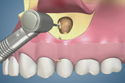 Apical Surgery-Premolar-No Sinus Tract